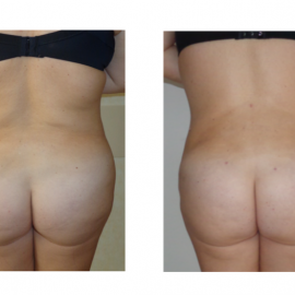 Liposcultura 1