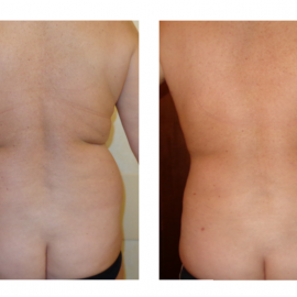 Liposcultura 2