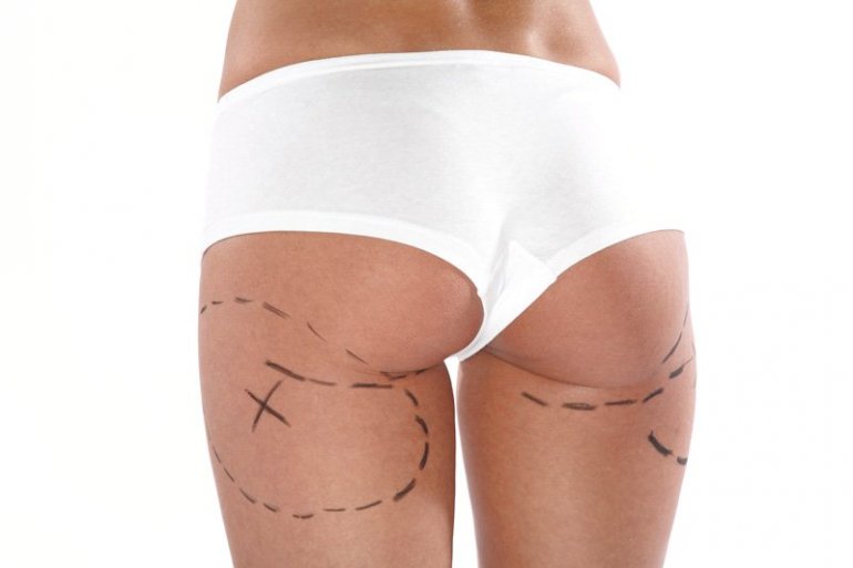 Liposuzione – Liposcultura e gluteoplastica