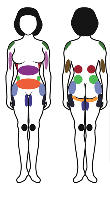 Punti di intervento liposcultura e liposuzione