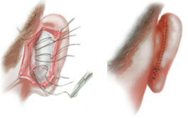 otoplastica