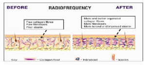 radiofrequenza roma